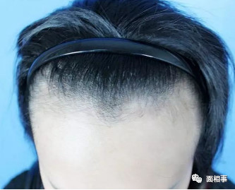 女人额头高说明什么？面相分析高额头的女人