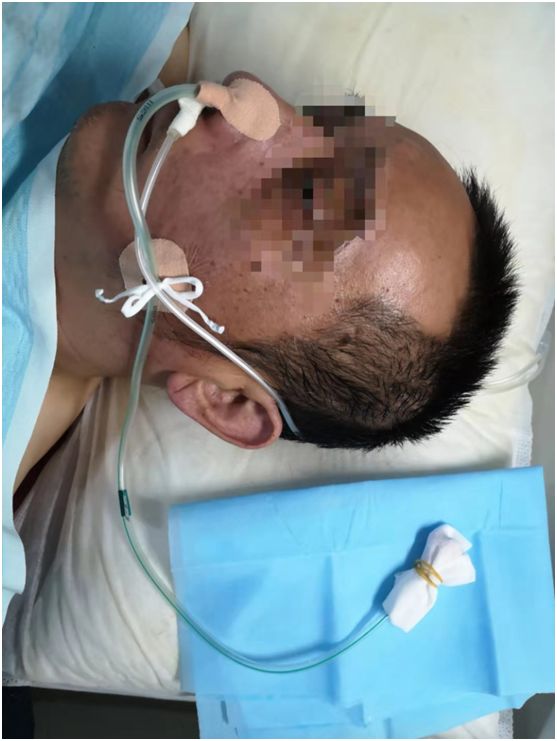 留置胃管鼻贴怎么贴鼻胃管固定不牢麻烦多？教你一种改良固定法~_https://www.jmylbn.com_新闻资讯_第4张