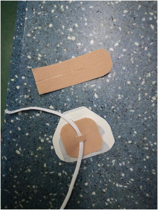 留置胃管鼻贴怎么贴鼻胃管固定不牢麻烦多？教你一种改良固定法~_https://www.jmylbn.com_新闻资讯_第3张