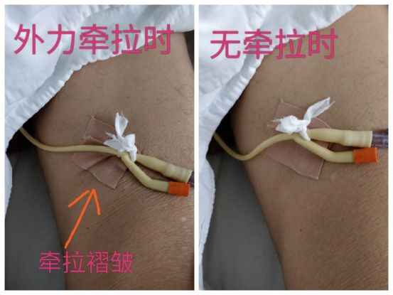 尿管怎么固定别人家的尿管固定法，你也值得拥有~_https://www.jmylbn.com_新闻资讯_第9张