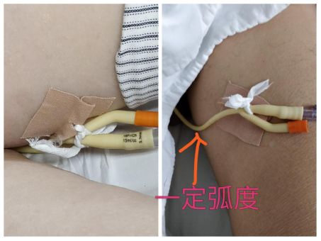 尿管怎么固定别人家的尿管固定法，你也值得拥有~_https://www.jmylbn.com_新闻资讯_第8张