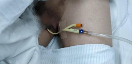 尿管怎么固定别人家的尿管固定法，你也值得拥有~_https://www.jmylbn.com_新闻资讯_第11张