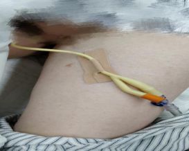 尿管怎么固定别人家的尿管固定法，你也值得拥有~_https://www.jmylbn.com_新闻资讯_第10张