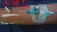 留置针怎么贴膜静脉留置针贴膜应该怎么贴？你的做法很可能是错的_https://www.jmylbn.com_新闻资讯_第6张