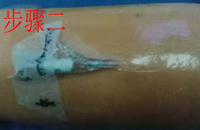 留置针怎么贴膜静脉留置针贴膜应该怎么贴？你的做法很可能是错的_https://www.jmylbn.com_新闻资讯_第3张