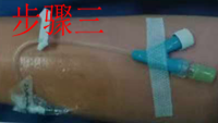 留置针怎么贴膜静脉留置针贴膜应该怎么贴？你的做法很可能是错的_https://www.jmylbn.com_新闻资讯_第4张