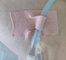 为什么要引流尿袋带回家的留置尿管，你知道怎么护理吗？_https://www.jmylbn.com_新闻资讯_第3张