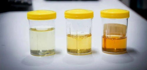 为什么要引流尿袋带回家的留置尿管，你知道怎么护理吗？_https://www.jmylbn.com_新闻资讯_第4张