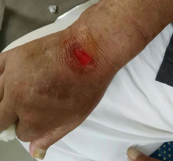 为什么输液管要粘上面慎重 ｜ 输液贴粘掉3cm×2cm的皮肤，这起医源性损害，转发提醒所有人_https://www.jmylbn.com_新闻资讯_第4张