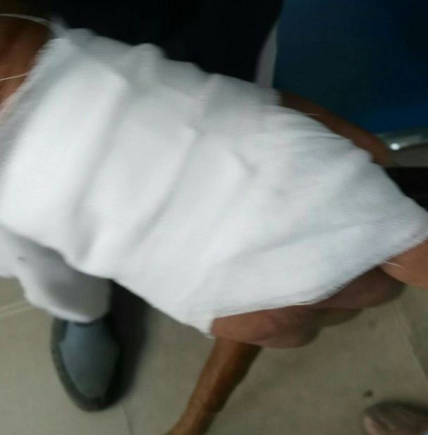 为什么输液管要粘上面慎重 ｜ 输液贴粘掉3cm×2cm的皮肤，这起医源性损害，转发提醒所有人_https://www.jmylbn.com_新闻资讯_第5张