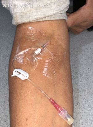 bd留置针怎么使用留置针固定4个要点，最后一个有问题_https://www.jmylbn.com_新闻资讯_第7张