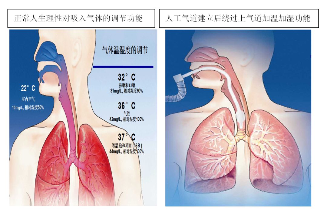 湿化液是什么常用气道湿化方式及湿化液_https://www.jmylbn.com_新闻资讯_第6张