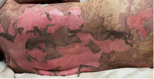 什么是凡士林纱布惨不忍睹！90%表皮脱落！大量渗液！发生了什么？_https://www.jmylbn.com_新闻资讯_第2张