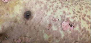 什么是凡士林纱布惨不忍睹！90%表皮脱落！大量渗液！发生了什么？_https://www.jmylbn.com_新闻资讯_第3张