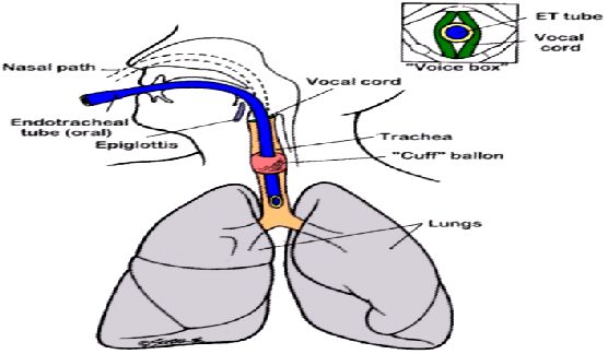 更不能完全阻挡气囊上滞留物的下移(见下面声门和气管插管示意图)