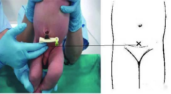 化验大便怎么采集宝宝腹泻，家长如何居家采集大便标本？这几点一定要注意！_https://www.jmylbn.com_新闻资讯_第8张