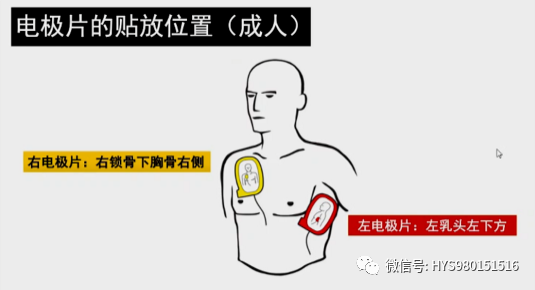 cpr按压板怎么放置关于心肺复苏需要掌握的知识点汇总_https://www.jmylbn.com_新闻资讯_第32张