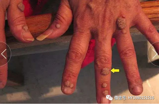 hpvdna分型分为什么型HPV病原学分型及临床应用_https://www.jmylbn.com_新闻资讯_第10张