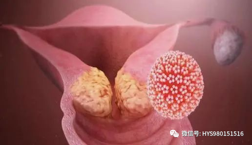 hpvdna分型分为什么型HPV病原学分型及临床应用_https://www.jmylbn.com_新闻资讯_第9张