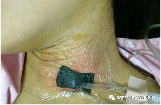 为什么负压引流伤口迁延不愈，这样处理有奇效_https://www.jmylbn.com_新闻资讯_第11张