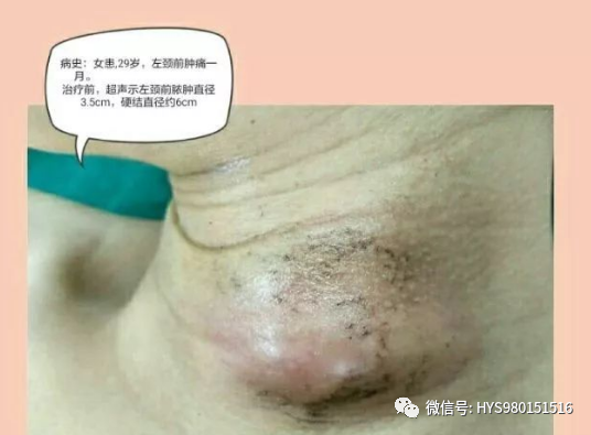 为什么负压引流伤口迁延不愈，这样处理有奇效_https://www.jmylbn.com_新闻资讯_第7张