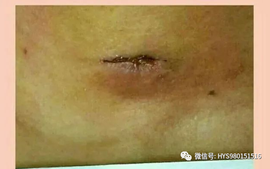 为什么负压引流伤口迁延不愈，这样处理有奇效_https://www.jmylbn.com_新闻资讯_第12张