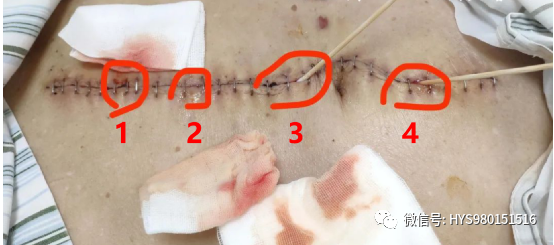 为什么负压引流伤口迁延不愈，这样处理有奇效_https://www.jmylbn.com_新闻资讯_第4张