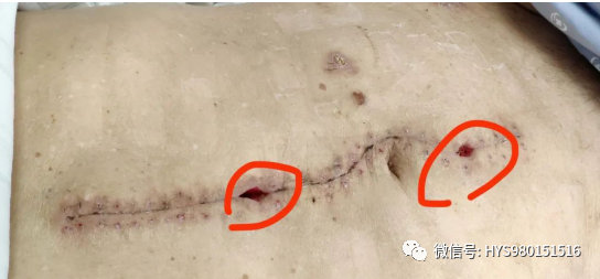 为什么负压引流伤口迁延不愈，这样处理有奇效_https://www.jmylbn.com_新闻资讯_第5张