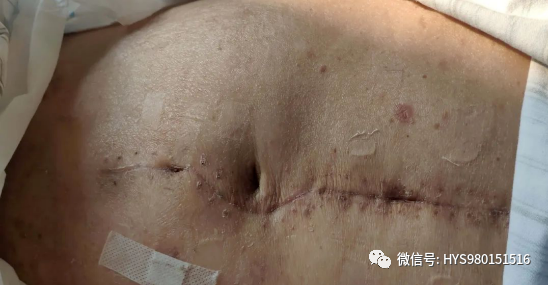 为什么负压引流伤口迁延不愈，这样处理有奇效_https://www.jmylbn.com_新闻资讯_第6张