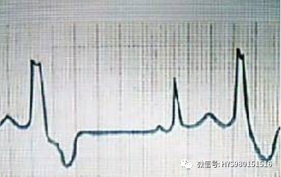 心电图纸的描述有哪些一文全解析 心电图到底该怎么看？_https://www.jmylbn.com_新闻资讯_第36张
