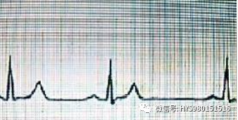 心电图纸的描述有哪些一文全解析 心电图到底该怎么看？_https://www.jmylbn.com_新闻资讯_第34张