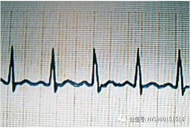 心电图纸的描述有哪些一文全解析 心电图到底该怎么看？_https://www.jmylbn.com_新闻资讯_第33张