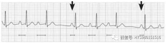心电图纸的描述有哪些一文全解析 心电图到底该怎么看？_https://www.jmylbn.com_新闻资讯_第41张