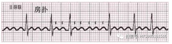 心电图纸的描述有哪些一文全解析 心电图到底该怎么看？_https://www.jmylbn.com_新闻资讯_第40张