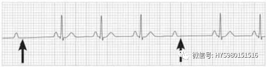 心电图纸的描述有哪些一文全解析 心电图到底该怎么看？_https://www.jmylbn.com_新闻资讯_第42张
