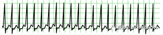 心电图纸的描述有哪些一文全解析 心电图到底该怎么看？_https://www.jmylbn.com_新闻资讯_第37张