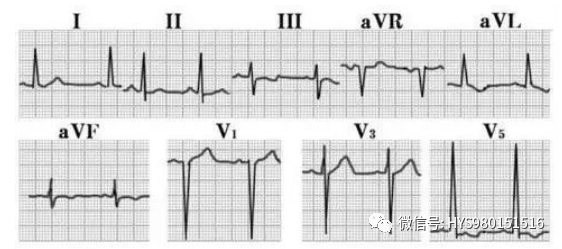 心电图纸的描述有哪些一文全解析 心电图到底该怎么看？_https://www.jmylbn.com_新闻资讯_第44张