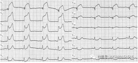 心电图纸的描述有哪些一文全解析 心电图到底该怎么看？_https://www.jmylbn.com_新闻资讯_第46张