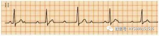心电图纸的描述有哪些一文全解析 心电图到底该怎么看？_https://www.jmylbn.com_新闻资讯_第43张