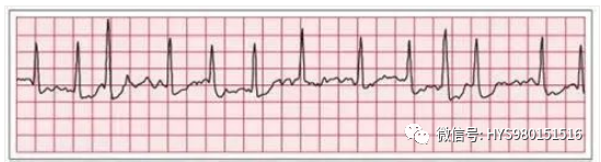 心电图纸的描述有哪些一文全解析 心电图到底该怎么看？_https://www.jmylbn.com_新闻资讯_第39张