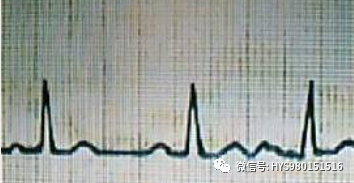 心电图纸的描述有哪些一文全解析 心电图到底该怎么看？_https://www.jmylbn.com_新闻资讯_第35张