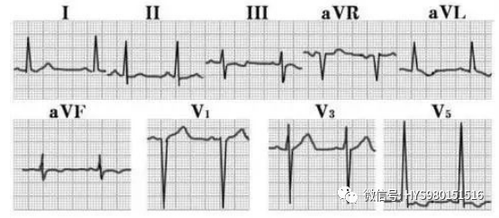 心电图纸的描述有哪些一文全解析 心电图到底该怎么看？_https://www.jmylbn.com_新闻资讯_第45张