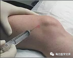 几丁糖有什么作用一文读懂膝关节腔内注射治疗！_https://www.jmylbn.com_新闻资讯_第3张