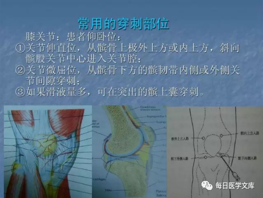 几丁糖有什么作用一文读懂膝关节腔内注射治疗！_https://www.jmylbn.com_新闻资讯_第2张