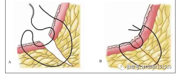 图12:进针点位于切口边缘约4mm垂直褥式缝合a,所示为缝合方式,避免