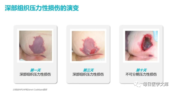 性敷料是什么压力性损伤的临床分期及措施_https://www.jmylbn.com_新闻资讯_第12张