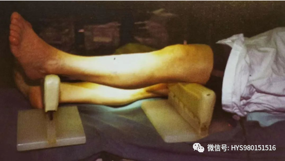 什么是外固定架胫骨近端骨折：环形外固定架_https://www.jmylbn.com_新闻资讯_第14张