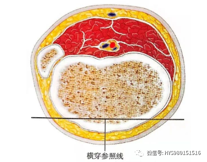 什么是外固定架胫骨近端骨折：环形外固定架_https://www.jmylbn.com_新闻资讯_第24张