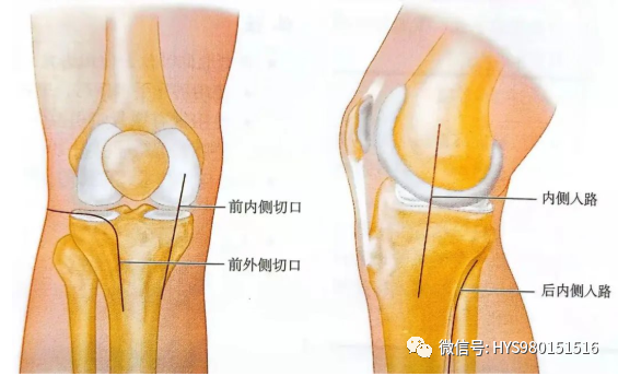 什么是外固定架胫骨近端骨折：环形外固定架_https://www.jmylbn.com_新闻资讯_第16张