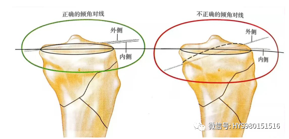 什么是外固定架胫骨近端骨折：环形外固定架_https://www.jmylbn.com_新闻资讯_第22张